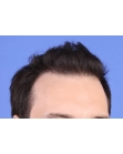 After Hair Transplant&nbsp;Front